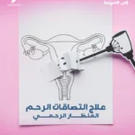 ما هي التصاقات الرحم؟