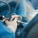 عملية منظار الرحم