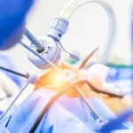 منظار البطن