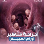 جراحة مناظير أورام المبيض الأستاذ الدكتور أحمد عبد المجيد